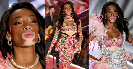 Modelka z bielactwem triumfuje na wybiegu Victoria's Secret