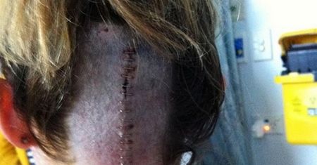 Lekarze myśleli, że to zwykła infekcja ucha. W jej głowie rozwijał się niebezpieczny guz mózgu