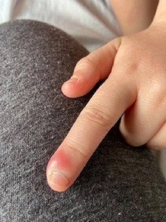 Obgryzanie paznokci było objawem cukrzycy 