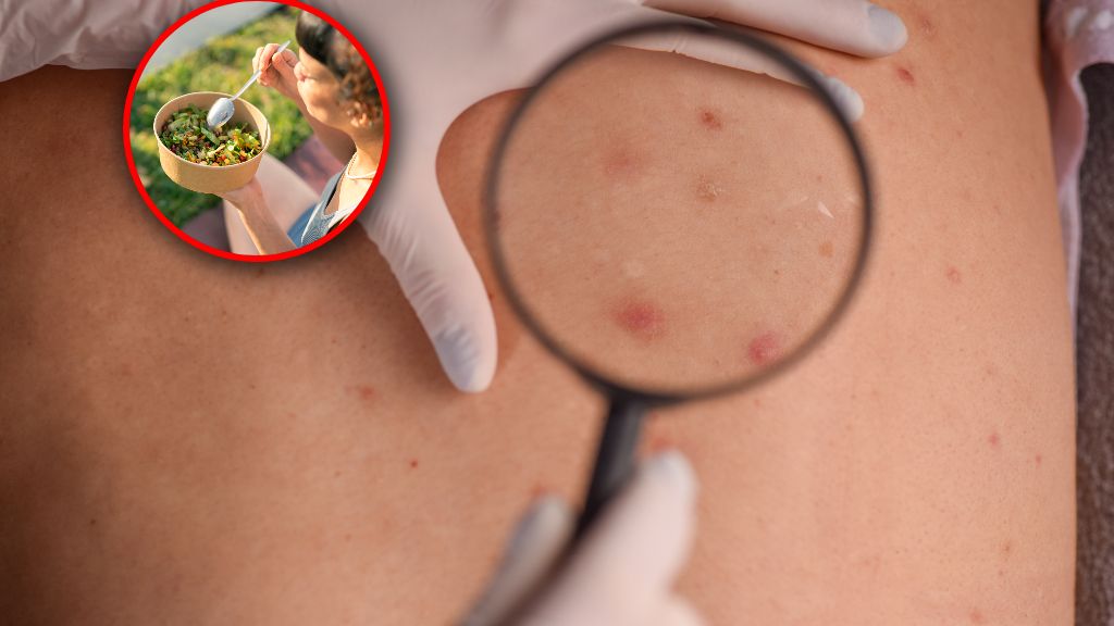 Właściwy skład mikrobiomu jelitowego może stać się jednym z czynników branych pod uwagę przy planowaniu leczenia czerniaka