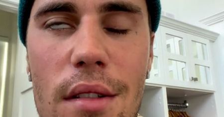 Justin Bieber sparaliżowany. Zespół Ramsaya Hunta. Co to za choroba?