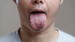 Język mosznowy to groźny objaw. Ujawnia poważne niedobory w organizmie