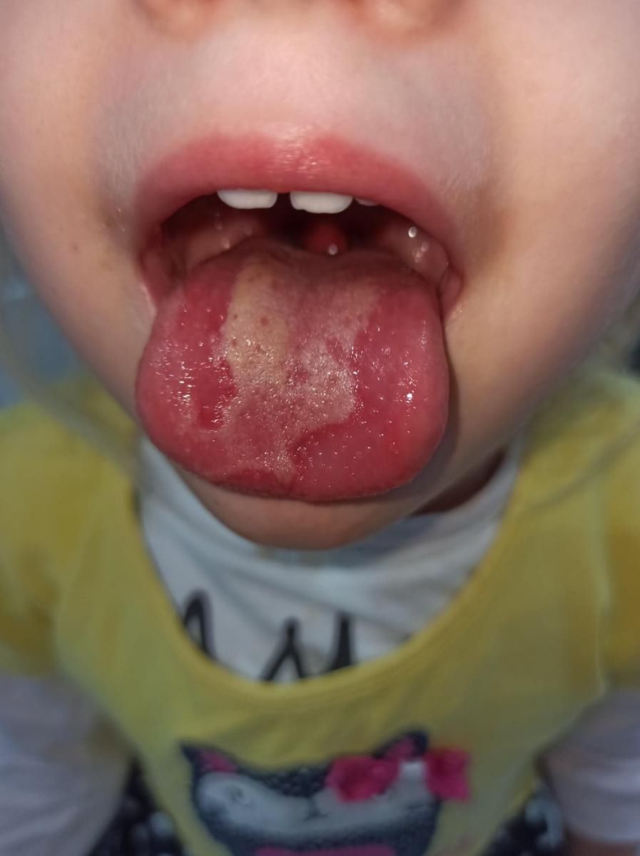 Jednym z objawów było owrzodzenie języka