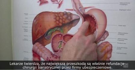 Wielkie zalety i wciąż utrudniony dostęp do chirurgicznej walki z otyłością