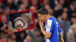 "Skaskował" go Bednarek. Tak wygląda noga piłkarza Nottingham