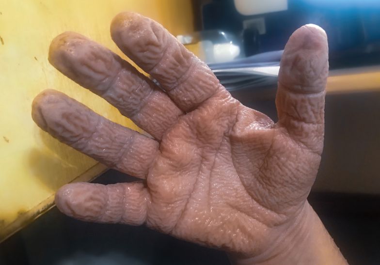 Nadmiernie pomarszczona skóra na dłoniach może być objawem wodnej keratodermii