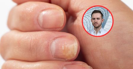 Przyczyny grzybicy. Dermatolog wymienia błędy, które jej sprzyjają