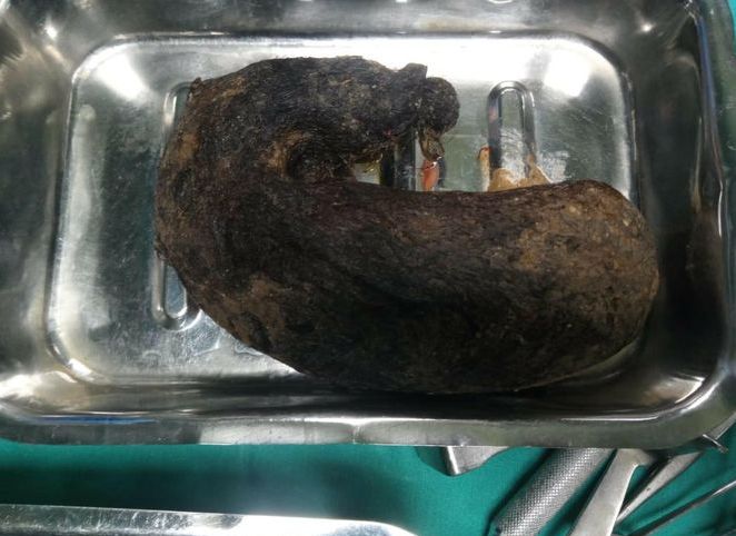 Trichobezoar w żołądku 9-latki