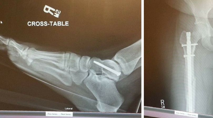 Lekarze musieli zamontować w kostce Audry specjalne śruby