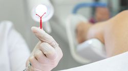 Skuteczność wkładek wewnątrzmacicznych