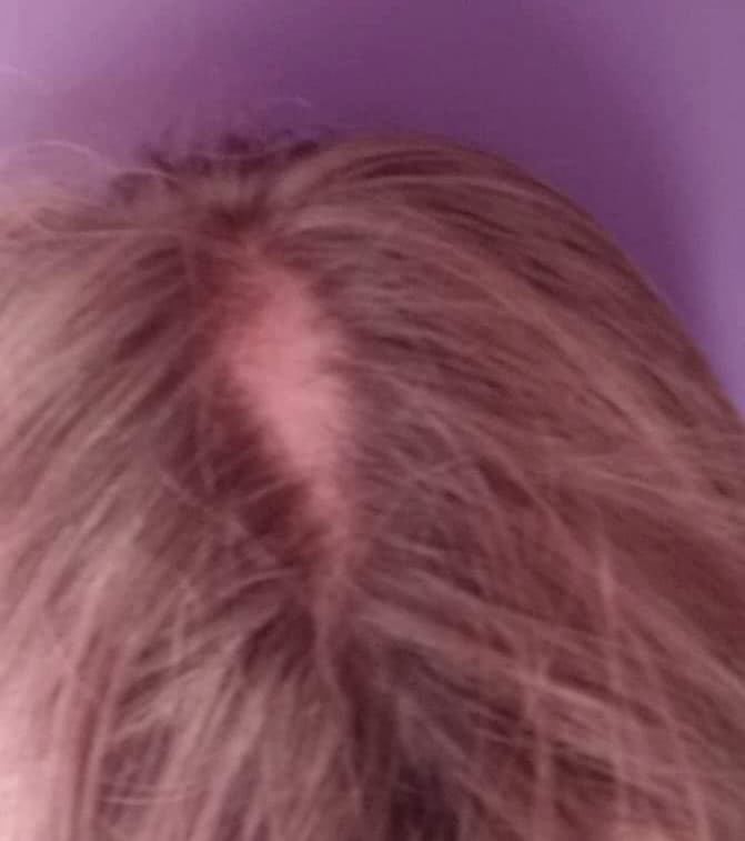 Głowa dziecka cierpiącego na trichotillomanię