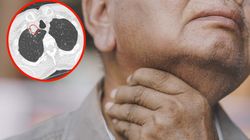 Znaleźli w jego tchawicy ropień. Winny był pospolity grzyb