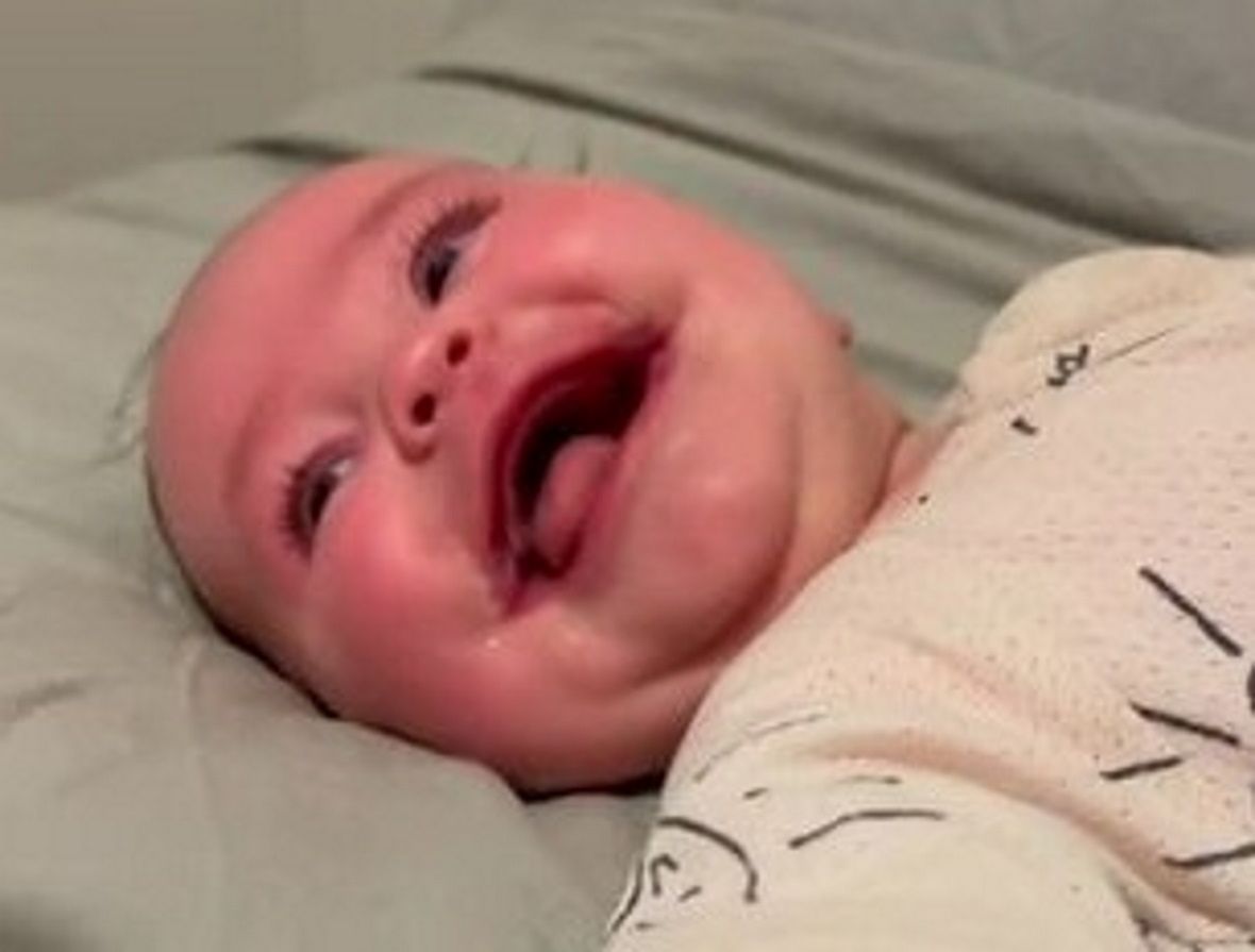 Dziewczynka cierpi na obustronną makrostomię