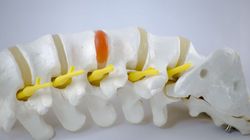 Dyskopatia - przyczyny, objawy, rozpoznanie, leczenie, zapobieganie