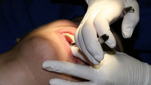 Implanty stomatologiczne - kiedy zabraknie zęba... 1