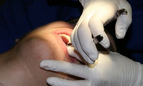 Implanty zębów - dlaczego warto? (fot.: morguefile.com)