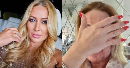 Sylwia Peretti pokazuje POPARZONĄ TWARZ po zabiegu laserowym za ponad 6 tysięcy (ZDJĘCIA)