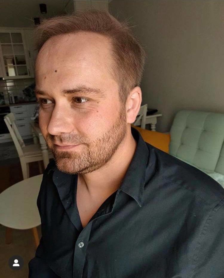 Adrian ze "Ślubu" pokazuje efekty przeszczepu włosów