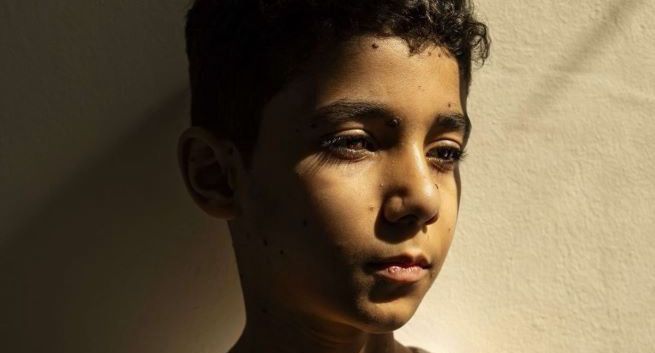 Oto Zdjęcie Roku w konkursie World Press Photo 2025. Przedstawia chłopca, który stracił rękę w Strefie Gazy