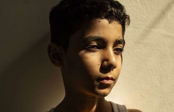 Oto Zdjęcie Roku w konkursie World Press Photo 2025. Przedstawia chłopca, który stracił rękę w Strefie Gazy