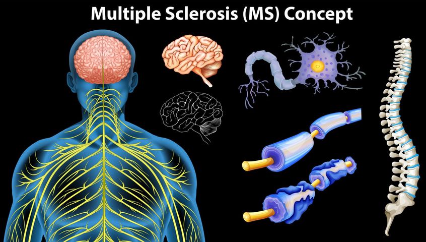 Stwardnienie rozsiane (łac. sclerosis multiplex, SM) to przewlekła choroba ośrodkowego układu nerwowego