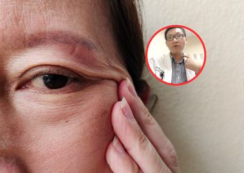 Charakterystyczny objaw tętniaka mózgu. Neurolog: Możemy to leczyć