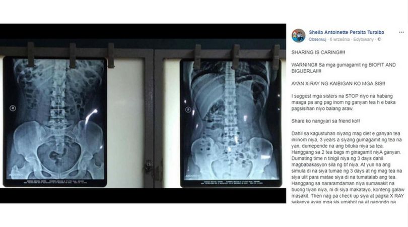 Zdjęcie rentgenowskie brzucha poszkodowanej dziewczyny oraz wpis na Facebooku