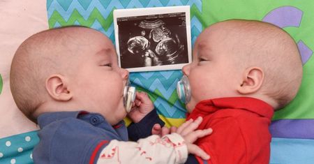 Bliźniaki trzymające się za rękę w łonie matki. Po porodzie dalej są nierozłączni
