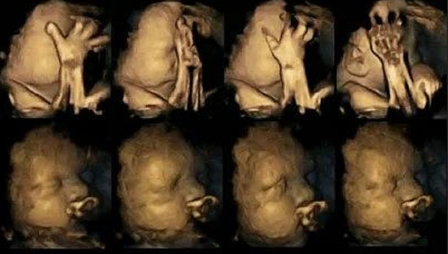 Na górze pokazany jest płód matki palącej a niżej matki niepalącej.