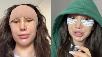 27-letnia Agata Lewandowska pokazała twarz tydzień po LIFTINGU: "Na razie wyglądam, jakby coś mi się stało" (WIDEO)