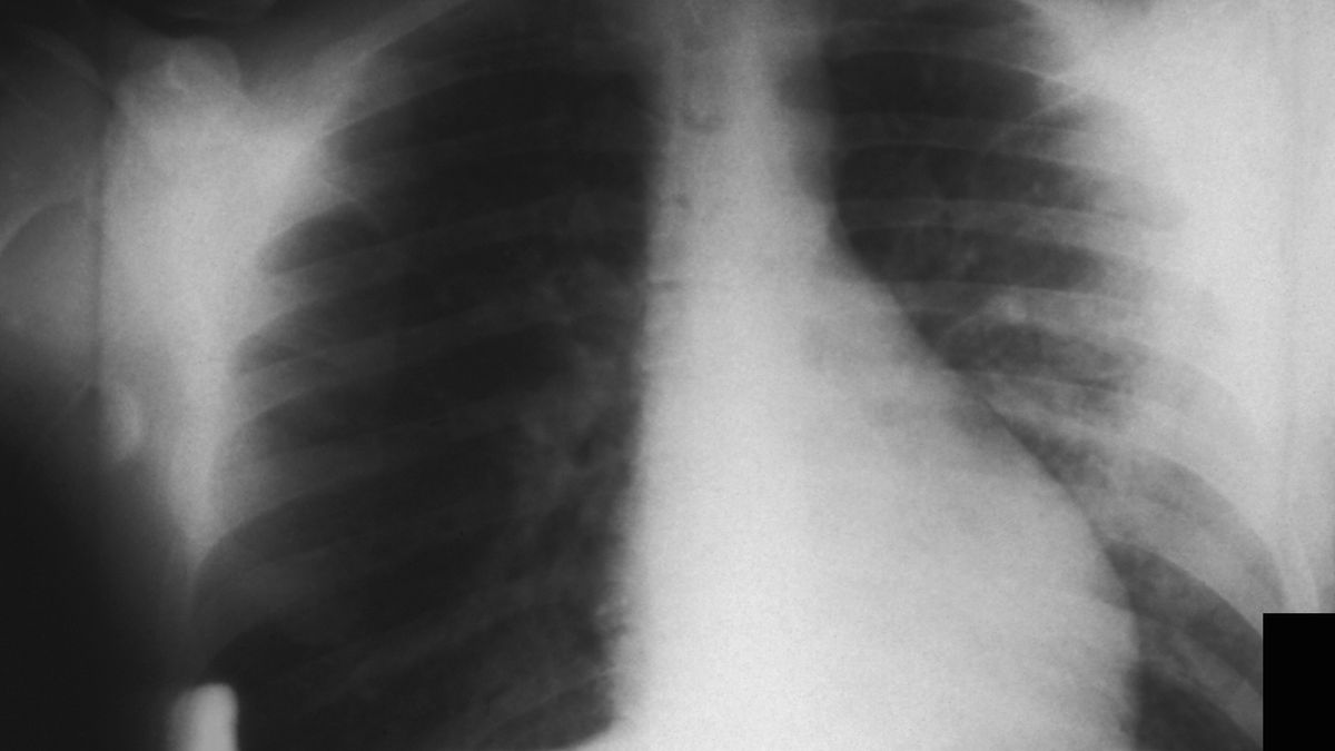 Płuca osoby zarażonej dżumą. Zdjęcie ilustracyjne