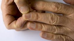 Pojawia się na paznokciach. Może świadczyć o chorej wątrobie