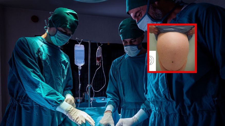 W warszawskim szpitalu w 2 godziny "odchudzili" pacjentkę o 21 kg. Tyle ważył guz