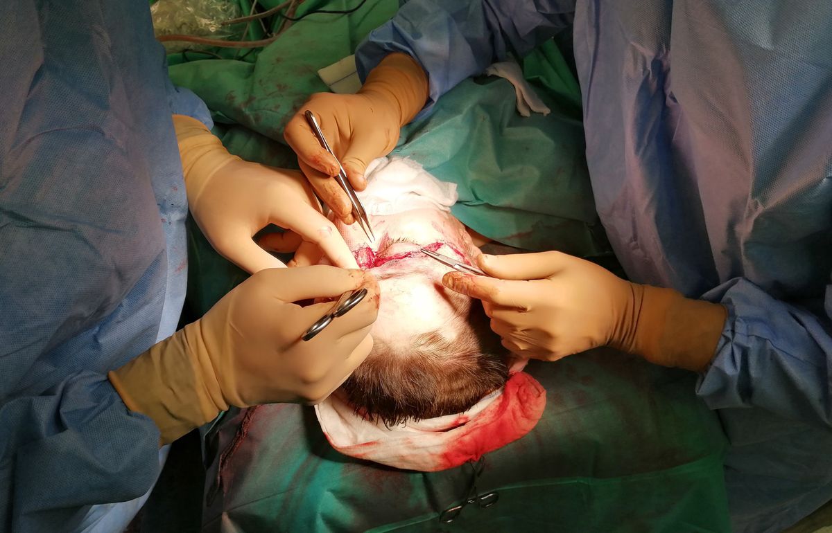 Śląskie. Zespół chirurgów Centrum Onkologii w Gliwicach przeprowadził pomyślnie zabieg replantacji skalpu u 39-letniej kobiety.
