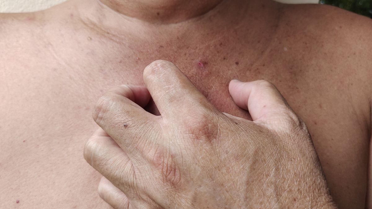 Jakie objawy daje cukrzyca?