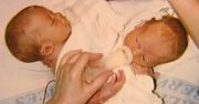 Jedna z bliźniaczek syjamskich urodziła. "To triumf medycyny"