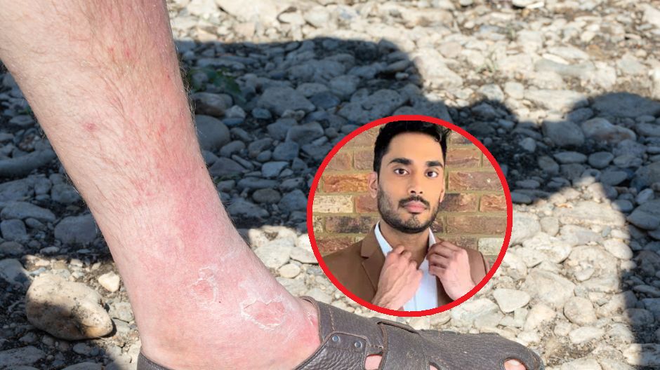 Jak w czasie upałów uniknąć zakrzepicy?