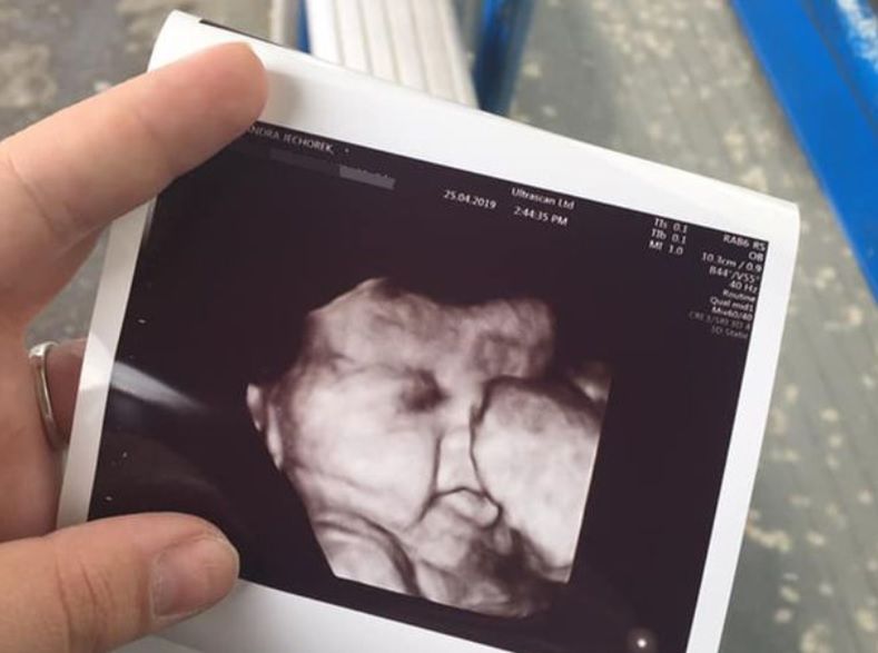 Włosy było widać już na USG