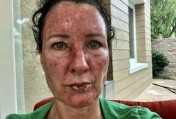 Była syrenka Stephanie Huff ma raka skóry. "Leżeliśmy na folii aluminiowej"