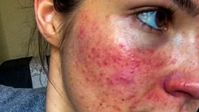 India cierpiała na trądzik różowaty