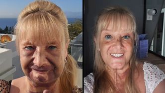 Jej zęby były w ruinie. Wyrwała je i wstawiła tureckie implanty. Pokazała EFEKT PRZED I PO (ZDJĘCIA)