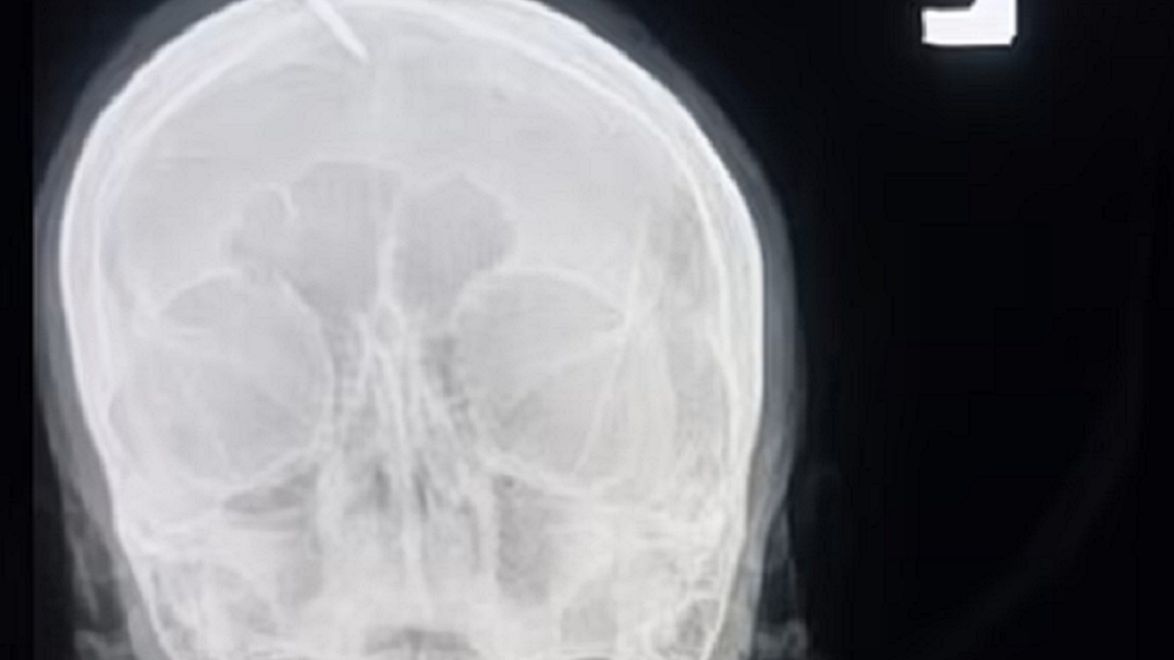 Kobieta ma w głowie gwóźdź, który miał zapewnić zmianę płci dziecka.