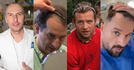 Oni PRZESZCZEPILI SOBIE WŁOSY! Znani panowie, którzy walczyli z łysieniem: Majdan, Qczaj, Koterski... Kto jeszcze poleciał do Turcji? (ZDJĘCIA)