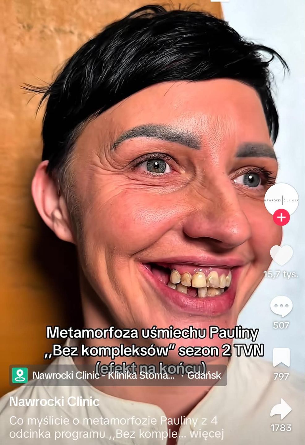 Metamorfoza zębów uczestniczki w programie "Bez kompleksów"