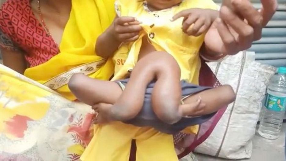 Urodziła się z dodatkową parą rąk i nóg