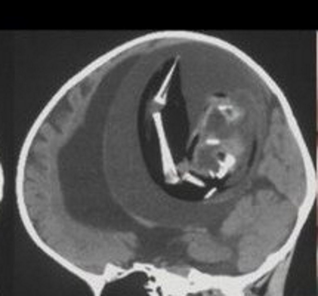 Pasożytniczy bliźniak w głowie