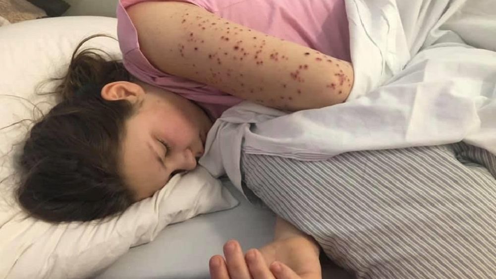 U 13-latki rozwinęła się silna wysypka