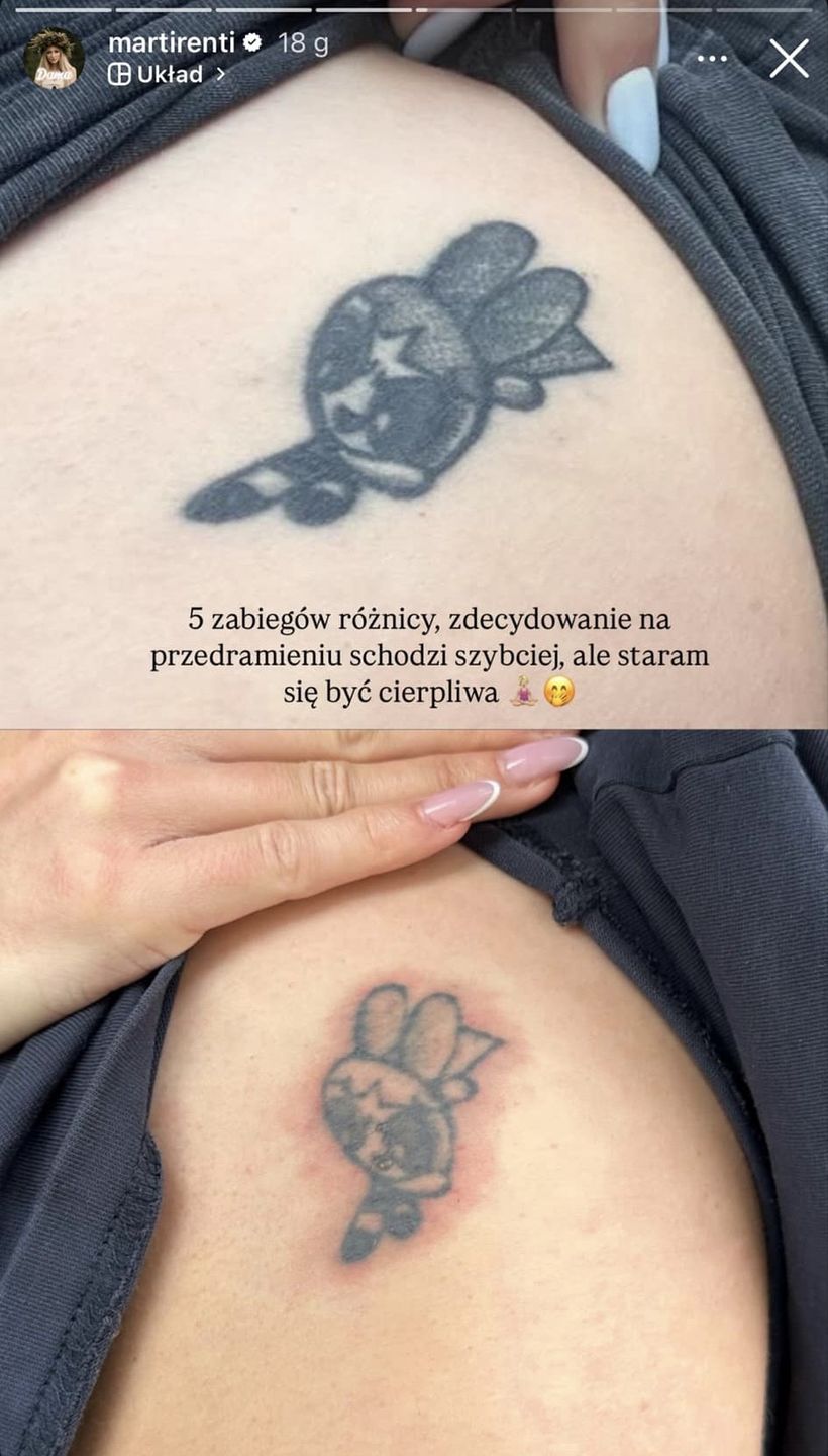 Martirenti usuwa tatuaże 