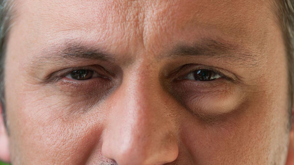 Worki pod oczami mogą mieć bardzo różne przyczyny.