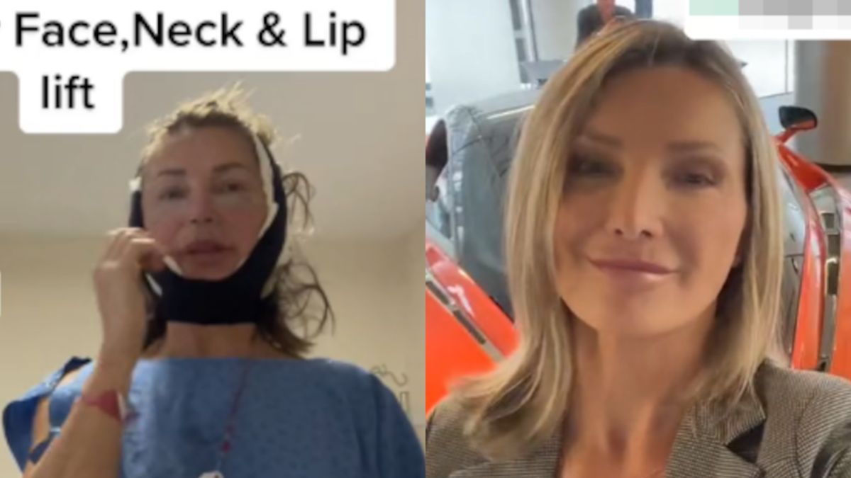 Przeszła "turecką metamorfozę" i wydała na to majątek. Zgadniesz, ile ma lat?